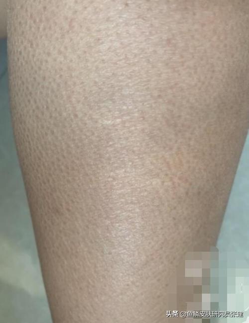 鱼鳞病一到秋冬季就起皮脱屑严重还伴有干痒其根源在这里