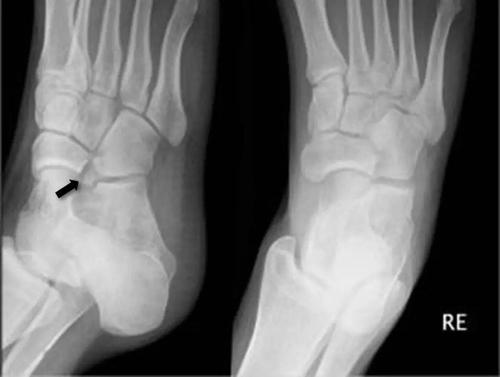 12种常见足踝部籽骨,小骨及变异