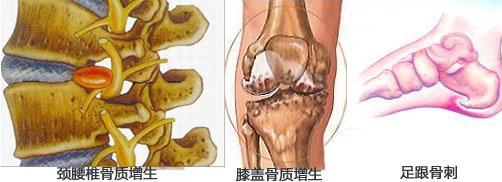 这样做不用手术也可治疗骨质增生