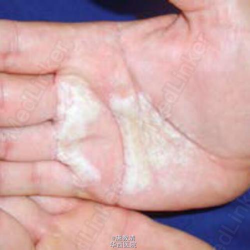 水源性角化病1例