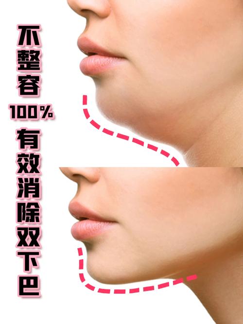 不整容0成本消除【双下巴】塑造完美下颌线_整容_瘦脸