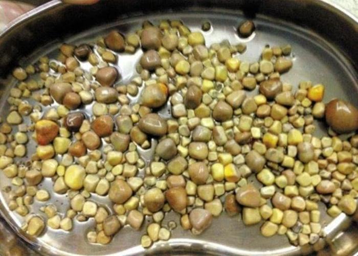 最让医生惊讶的是,所有胆结石的尺寸和形状都差不多.