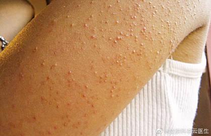 图一:毛周角化病