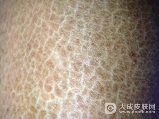 是先天的还是后天的,都对我们的生活造成了影响,蛇皮肤病不但会对我们