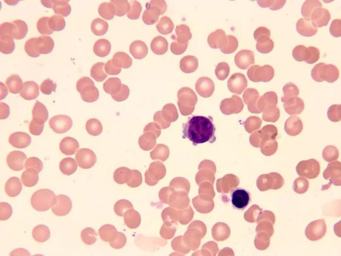 图为原始巨核细胞 提示m7,mds