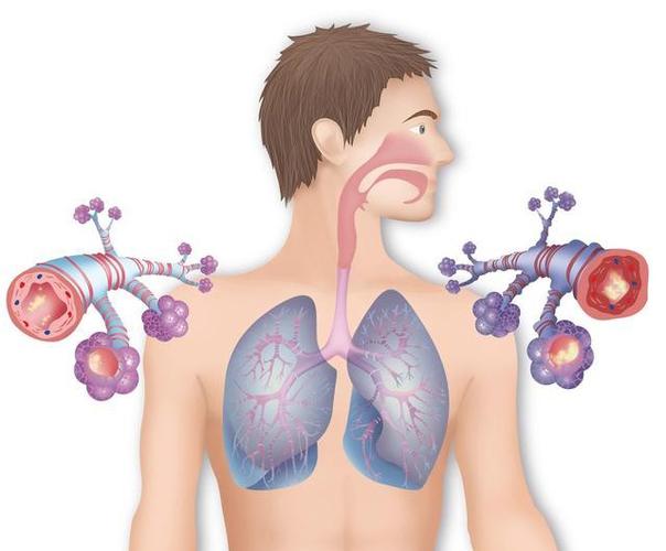 支气管扩张做到这一点,可以保持长期不发作,加上服用这个药更好