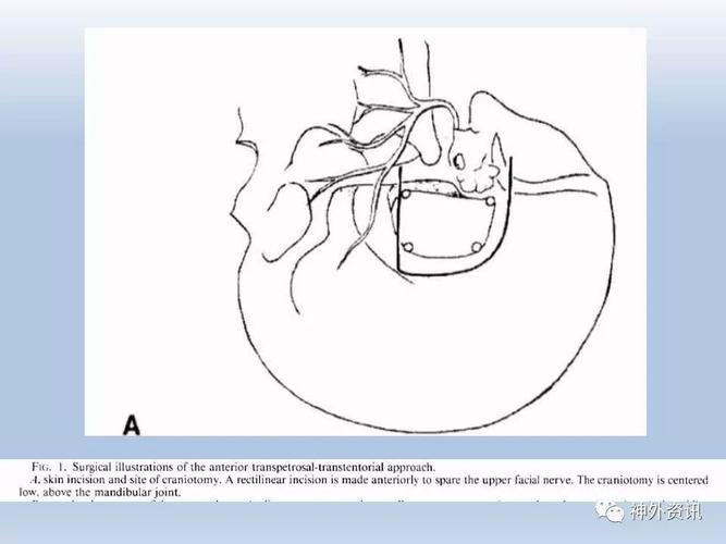 学习园地丨kawase三角与岩前入路经典文献(三)