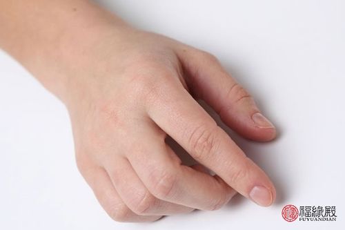手背有胎记是什么命 手背有胎记含义