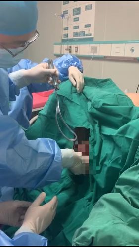 那坡人民医院首例剖宫产术中产钳助产术.