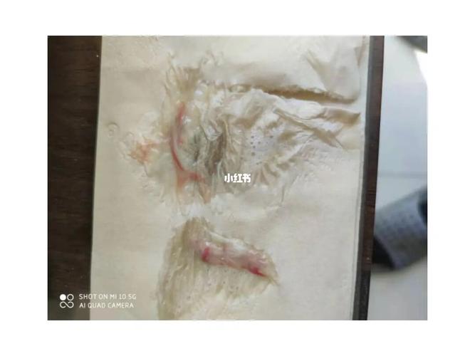 先生早期肺癌手术近一年,今天突然痰中有血.让我的头一下蒙了.