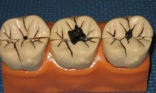 蛀牙早期黑点能刷掉吗口腔师深度科普蛀牙全干货