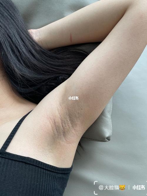 腋窝脱毛后肿么改善腋下黑呢?
