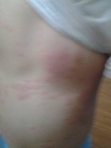 今天小孩突然肚子和背上长满了红斑,是怎么回事,不痒,该怎么治疗,2岁4