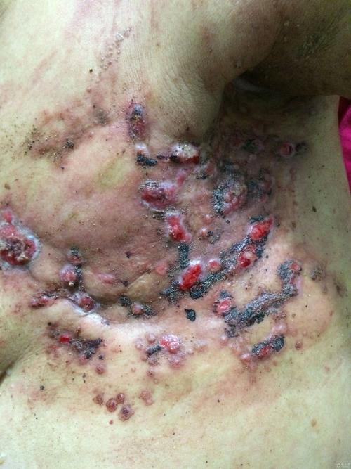 左侧乳腺癌术后溃疡