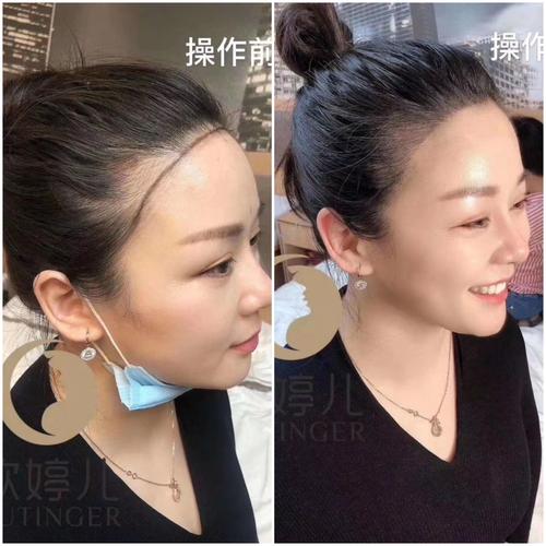 明星同款发际线