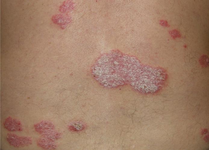 银屑病「牛皮癣」是真菌感染所致的「癣病」吗?