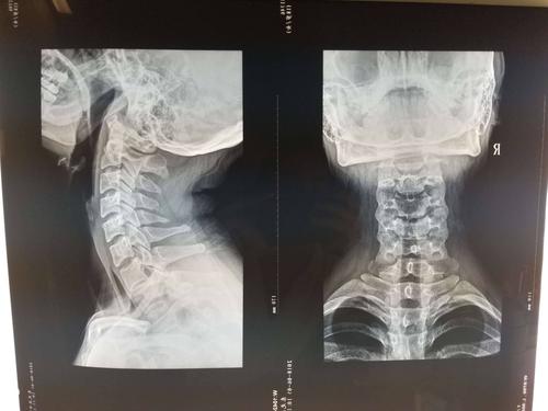 颈椎正侧位片