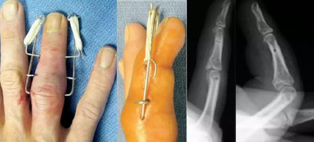 克氏针的n种神奇用法