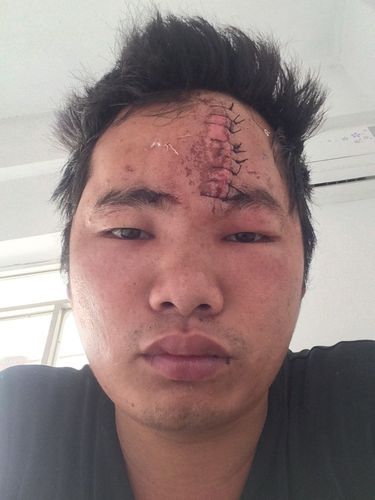 额头上有10厘米长的伤疤缝了10针能鉴定几级工伤