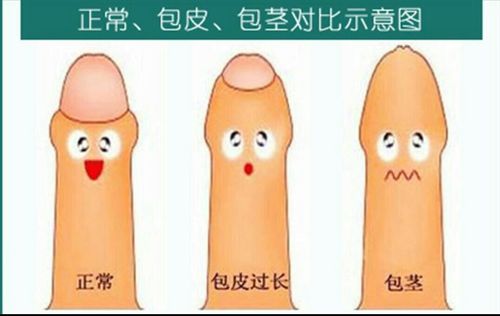 包皮过长是包皮覆盖于全部阴茎头和尿道口,仍可上翻;包茎是指包皮口