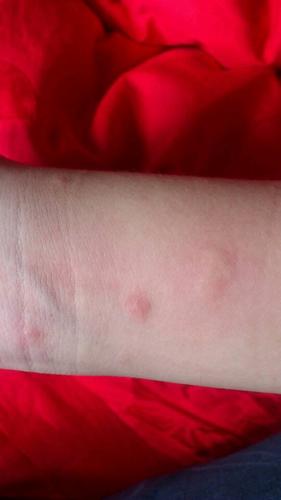 身上长这个不是虫子咬的又痒的包子是什么原因造成的?