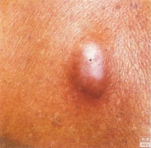 有的是在眼睑下方,有的在腹部等等,那么脂肪瘤到底首页 肿瘤科 脂肪瘤