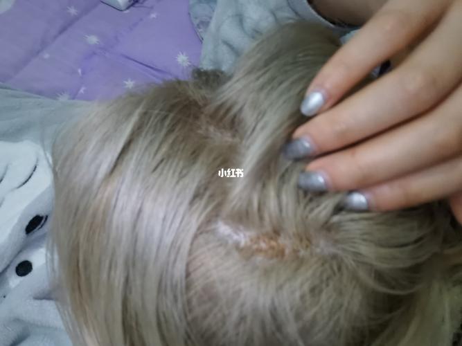 漂了个头发 上色时疼哭 第二天头皮直接结痂_上色_显白_西华大学自由