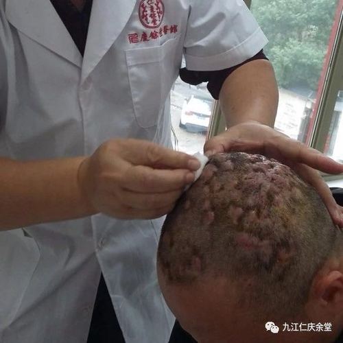 穿凿脓肿性头部毛囊炎 (俗称:鳝拱头)