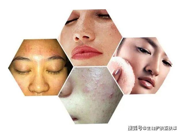 问题性肌肤是属于皮肤亚健康的一种状态,它与我们人体的内外都是有