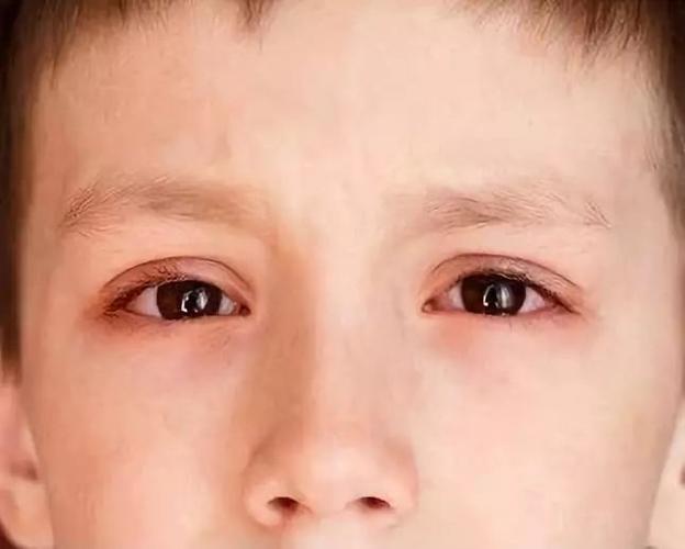 3分钟内看完这篇文章,儿童眼外伤常见急救误区及正确做法,一定要收藏!