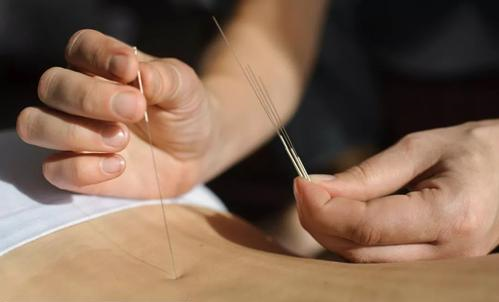 针灸说 | 腹针到底是什么?_手机搜狐网