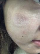 脸癣是什么样子的?如何治疗呢?