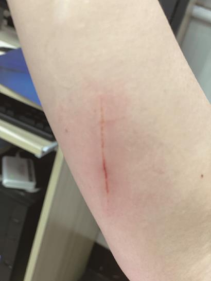 手臂上划出8厘米长伤口