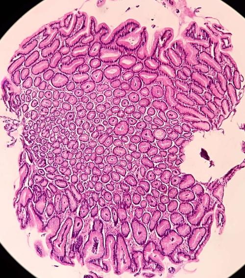 常见病的病理诊断(一)——慢性萎缩性胃炎