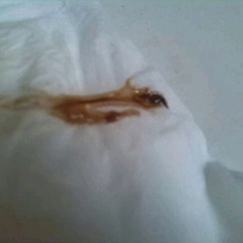 血性白带是什么原因导致的哪?它是