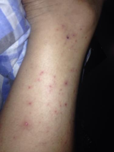 手脚皮肤瘙痒,起红疙瘩 喝酒后皮肤瘙痒一挠就起红疙瘩是酒精过敏