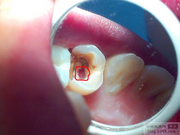 意见,图片是我自己拍的不是很清楚大家将就着看吧, 这个牙齿是牙痛在