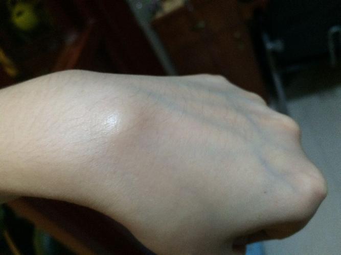 手背处多了个包一样的东西,平放的时候没什么异常,手腕向下弯曲的时候