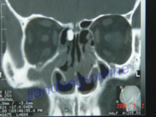 鼻窦ct
