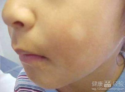 白色糠疹病不难治,在医治白色糠疹的时分,除了坚持脸部清洗以外,还