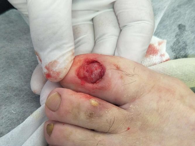 写美篇        在传统的手术治疗中,多以拔出甲板,通畅引流为主,但