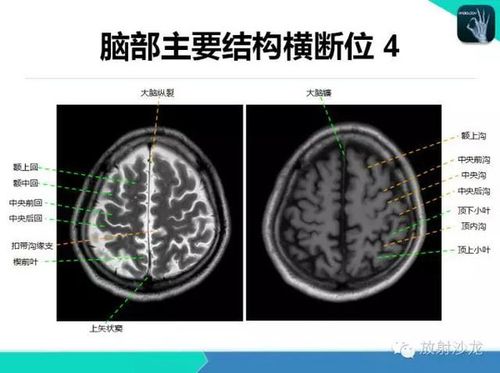 超详细!颅脑mri常用解剖