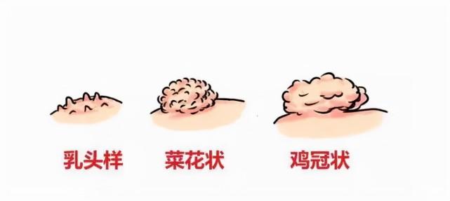 可以在体表所有部位生长,最终呈现为菜花状的"疙瘩",摸起来较柔软