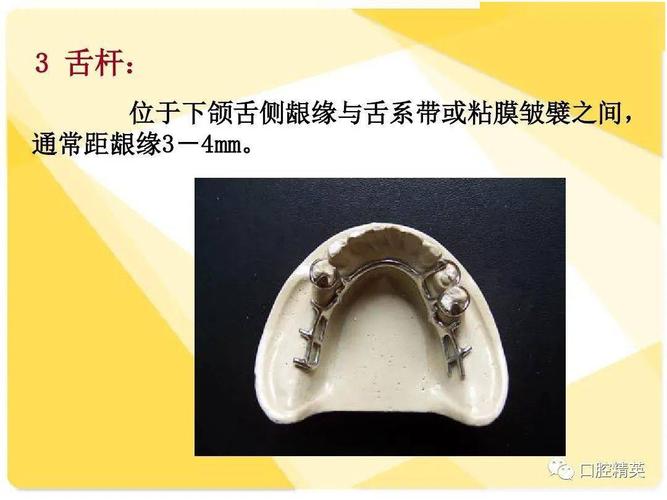 可摘局部义齿-结构