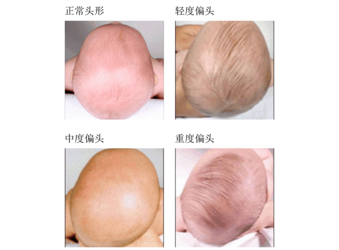 给孩子睡扁头了,长大必恨你!文末有福利!