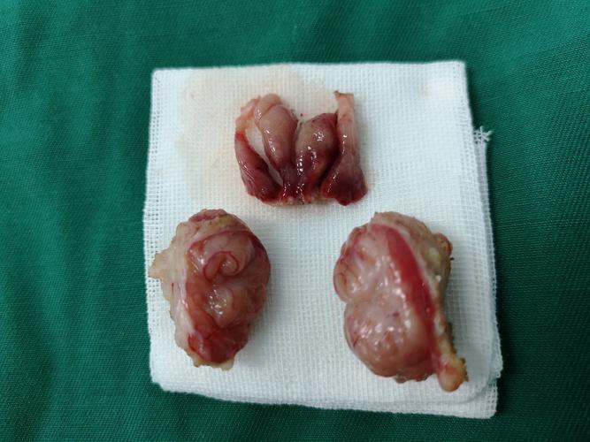 腺样体完整切除后不会复发