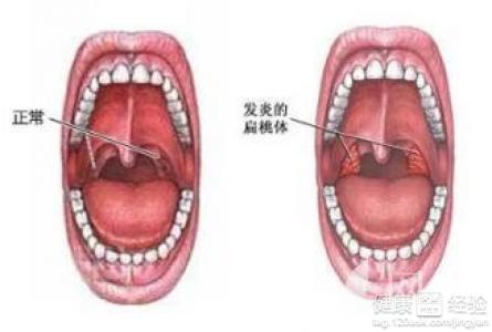 概 述 我的一个朋友说扁桃体发炎的时候可以吃韭菜,说的是这个东西