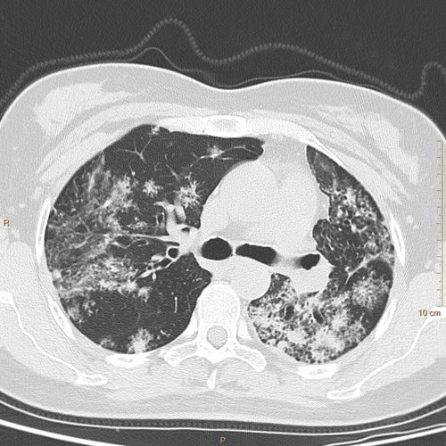 30年前患结核,咳嗽一年,干咳,无痰,无血丝,无发热