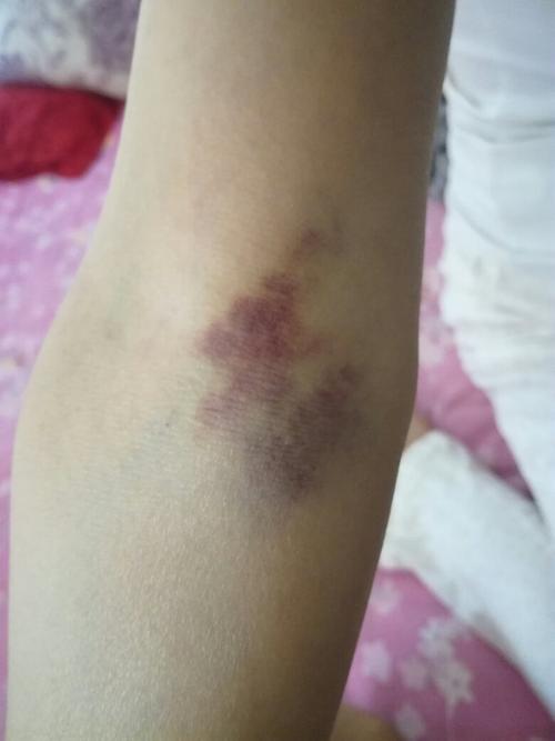 五天前胳膊抽血了,一直没注意,今天突然发现一大块青紫,不知道怎么