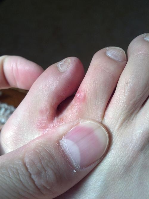 小脚趾和旁边脚趾间长了些小疙瘩